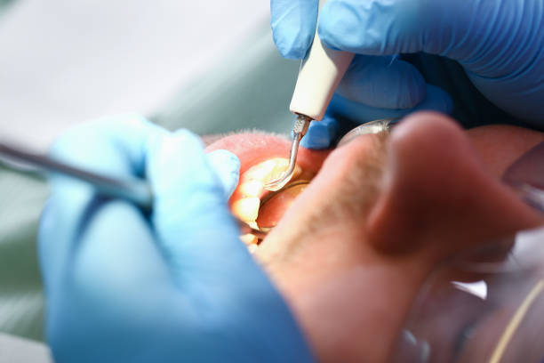 Best Emergency Dentist for Lost Fillings or Crowns in Biglerville, PA